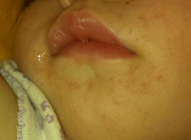 это аллергия или слюни??