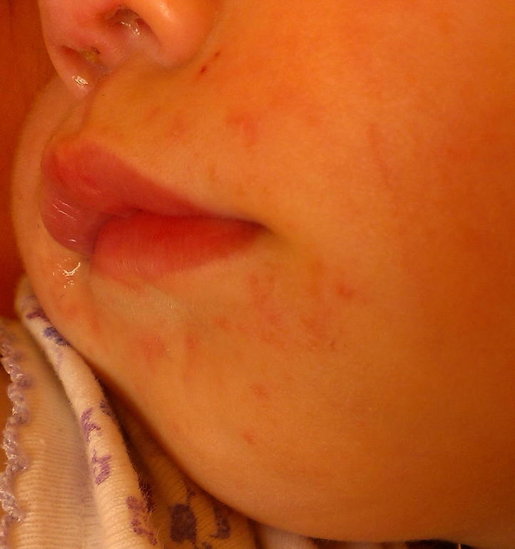 это аллергия или слюни??