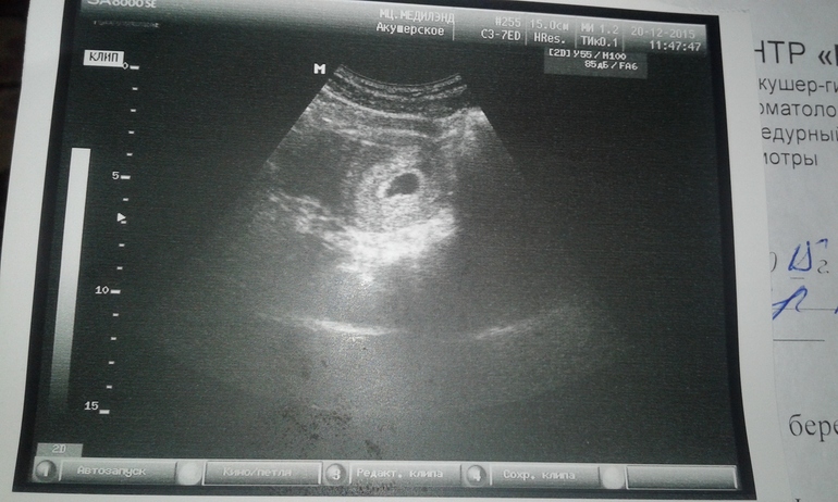 Узи беременности плодное яйцо 4 недели. Плодное яйцо 6 мм форум. Плодное яйцо 6 мм форум. Плодное яйцо 6 мм форум. Плодное яйцо диаметром 6 мм.