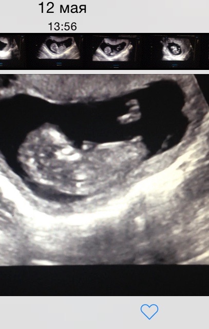 Мальчик девочка на узи в 15 недель беременности thumbnail