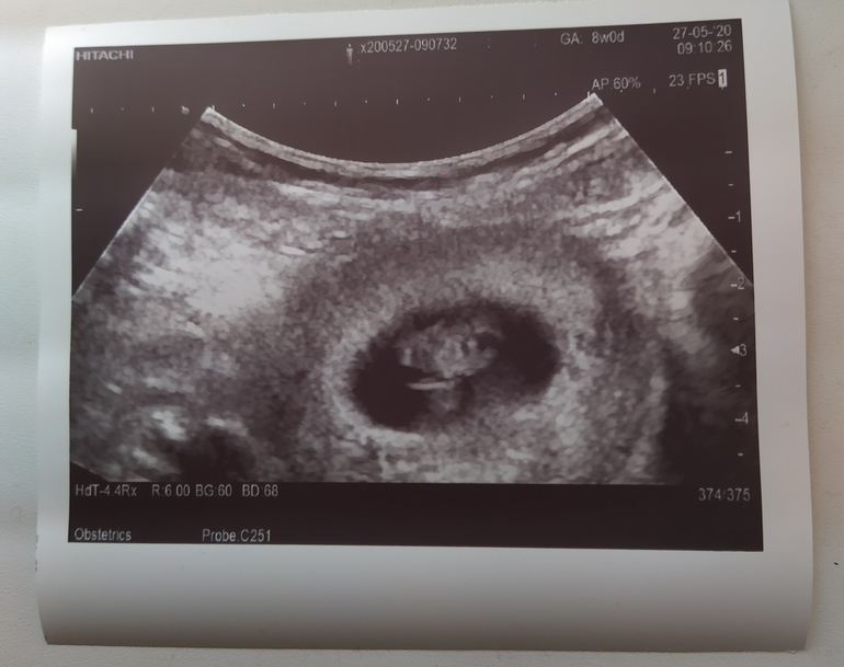 Как выглядит хорион на 6 неделе беременности фото