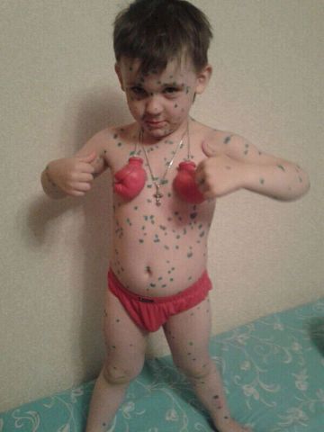 История ветрянки. Гордей.