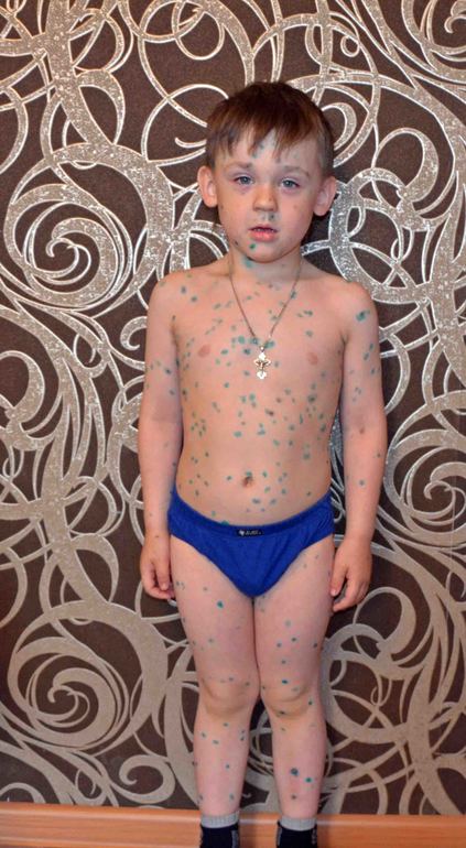 История ветрянки. Гордей.