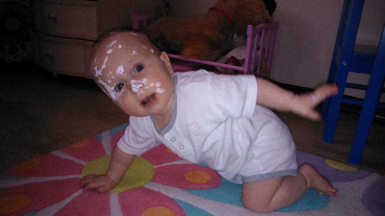 Ветрянка в 6 мес