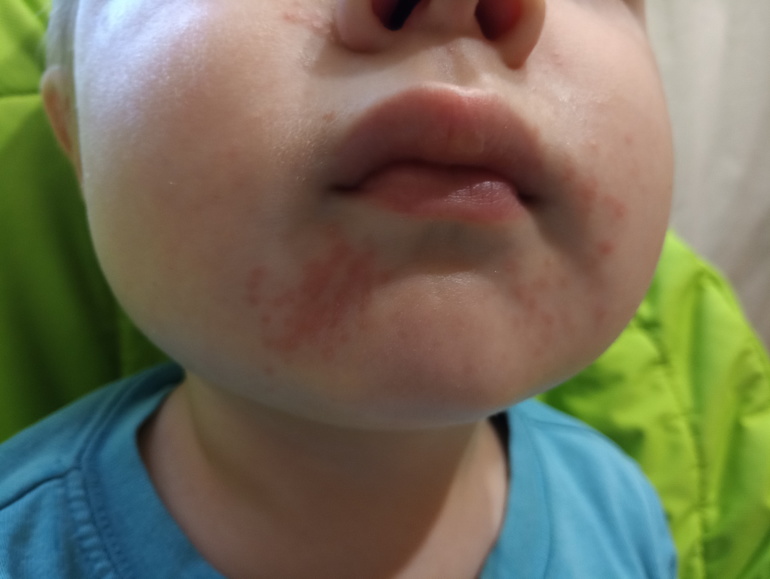 Раздражение кожи вокруг рта у ребёнка: что случилось с малышом?