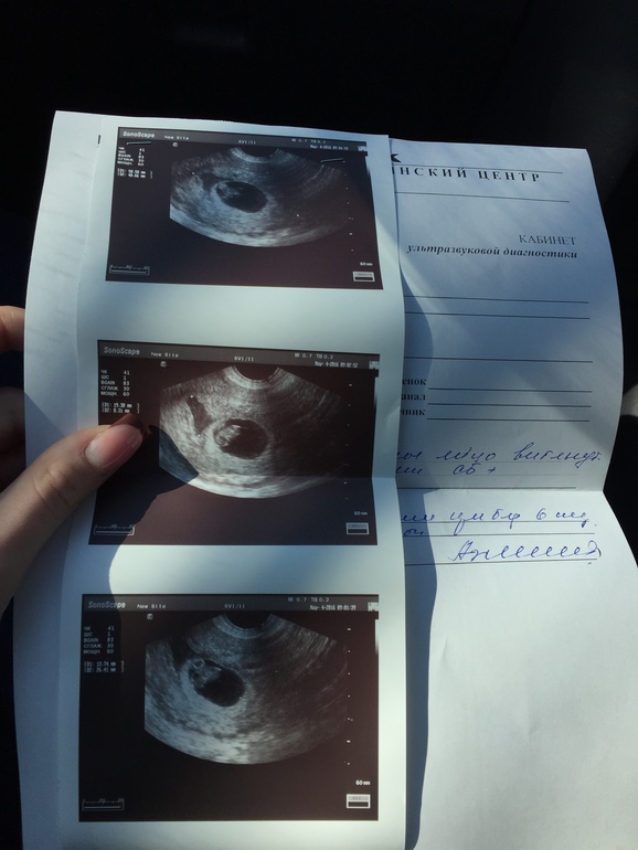 Узи 6 месяцев. Снимки УЗИ беременности. Снимок УЗИ беременности 6 месяцев.