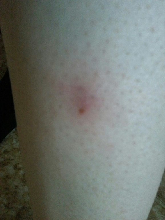 Воспаление ранки