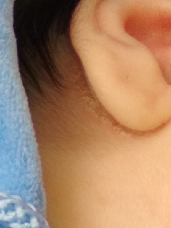 Золотуха у детей за ушами: лечение, причины и симптомы