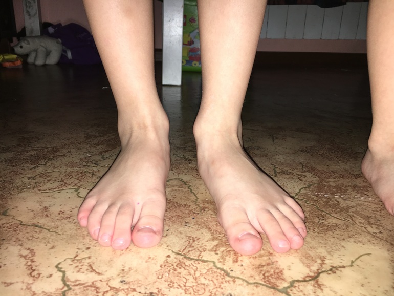 Одна нога сильнее другой. Ноги подростка. Длинные пальцы на ногах у ребенка. Искривление левой стопы.