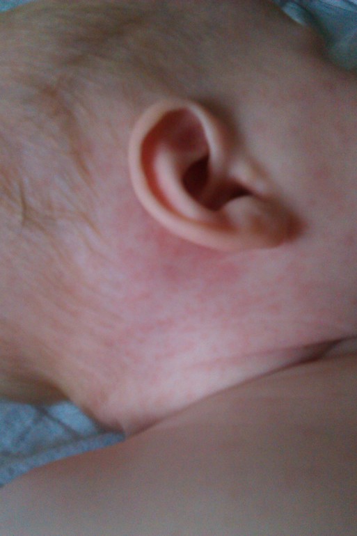 Розеола видимо.