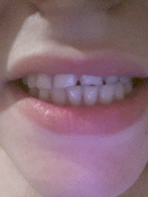 Что за зубы у меня :(