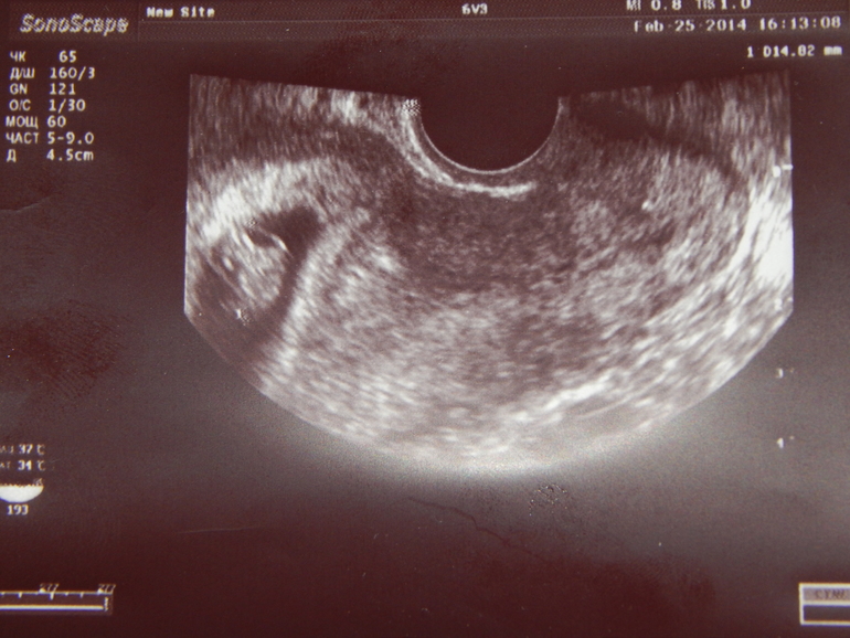 Первое УЗИ