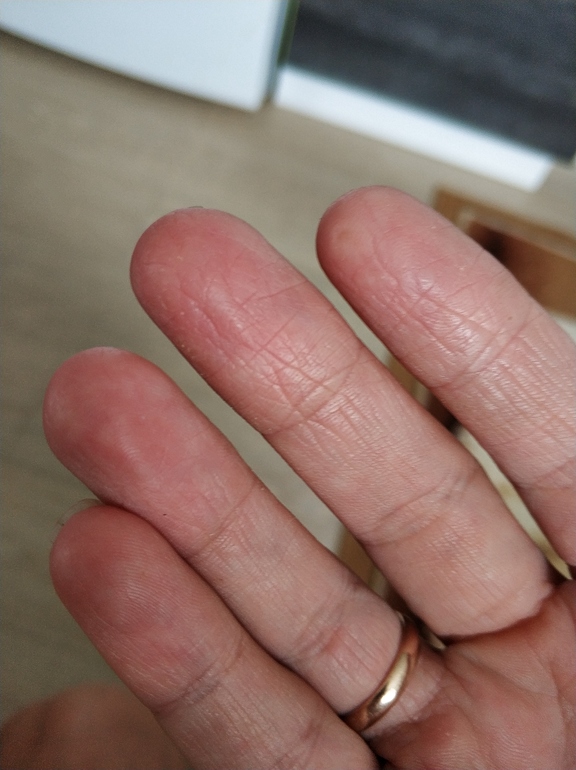 Трещины на пальцах рук и пятках: что поможет?