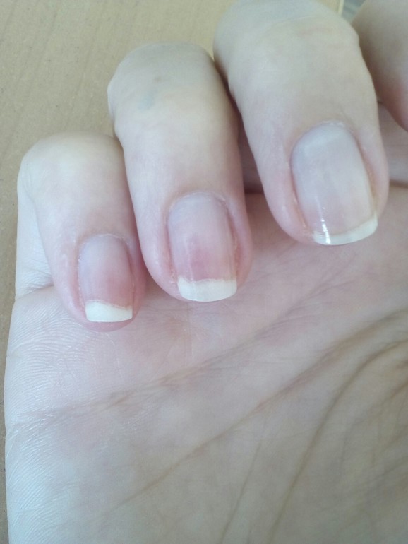 Отслойка гель лака от ногтя. Отслойки на ногтях гель лака. Почему ногти отходят от натурального ногтя. Почему ногти отходят от натурального ногтя. Литеральный онихолизис.