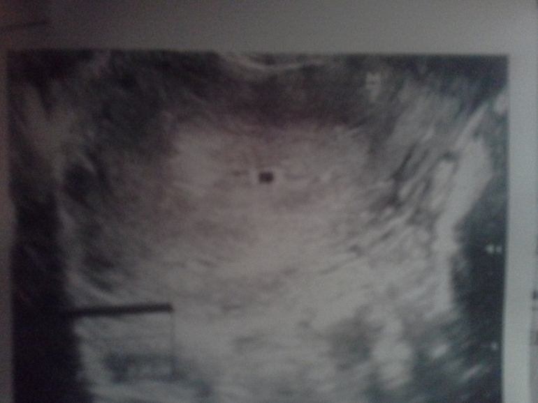 мое первое узи