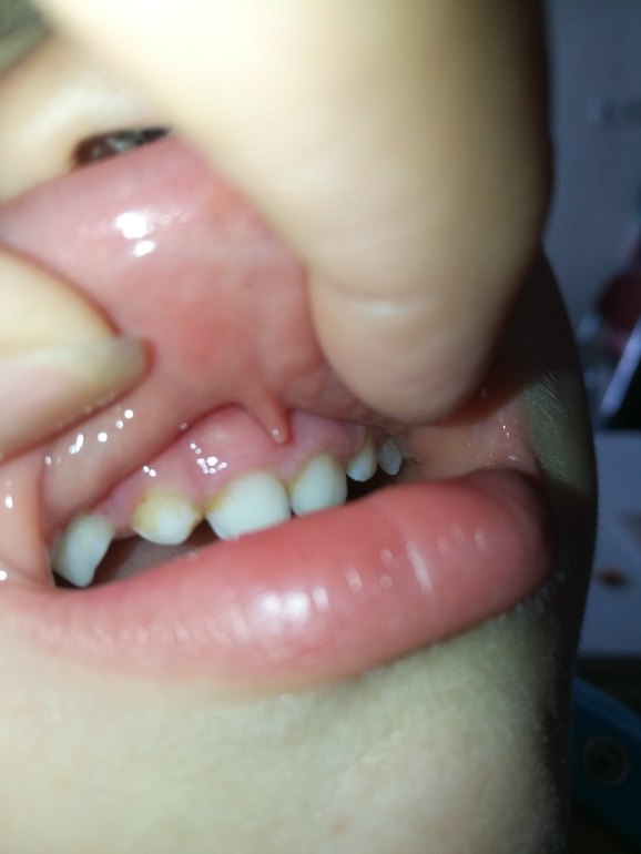 Гипоплазия эмали зубов