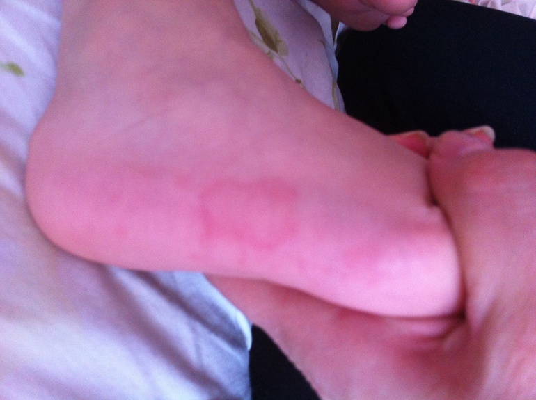 Что за пятна на стопах?