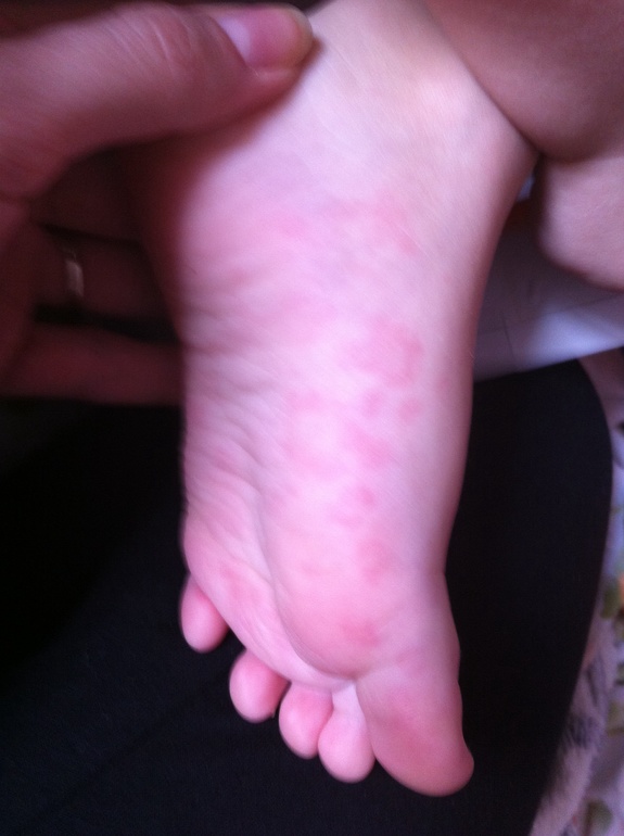 Что за пятна на стопах?