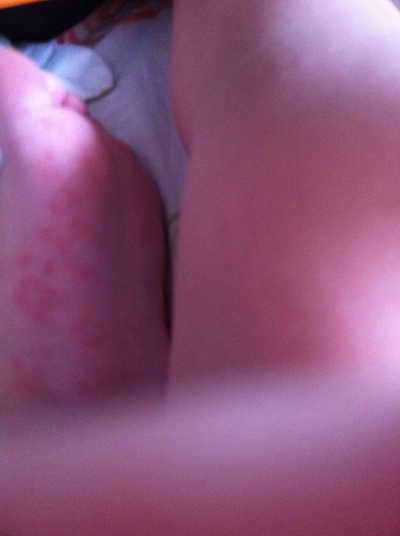 Что за пятна на стопах?