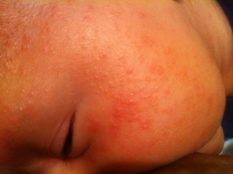 Точно аллергия? Или может быть все таки нет...фото внизу.