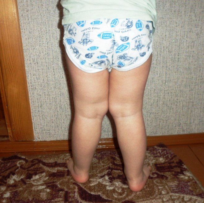 Что делать с вальгусом?