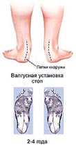 Формы ног и свод стоп ребенка