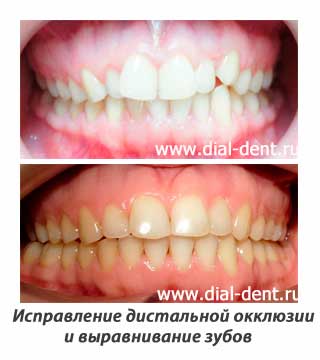 Дистальный прикус — лечение брекетами Damon