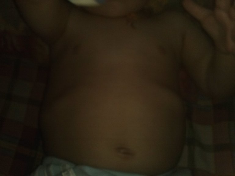 что это? рахит?