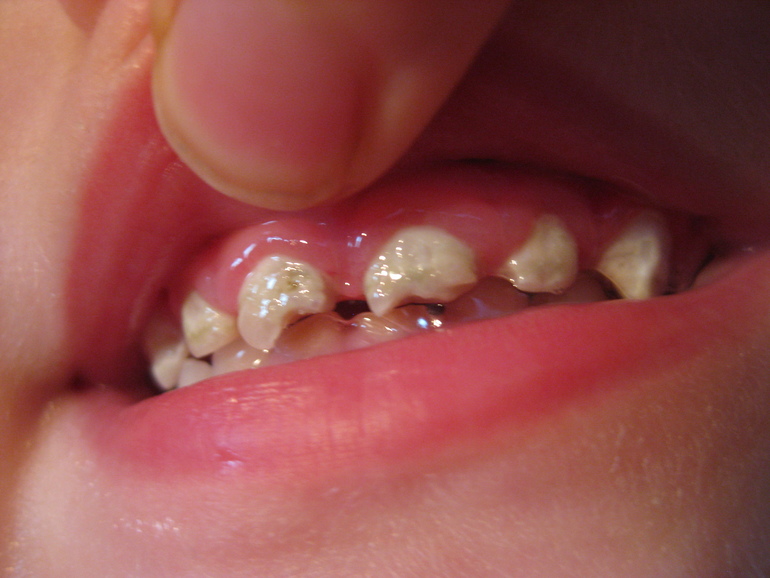 Лечить ли под наркозом Севоран или ждать, когда подрастет.