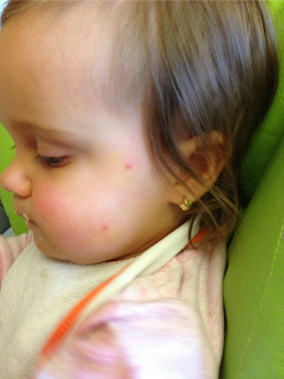 Что за прыщики? Сыпь?