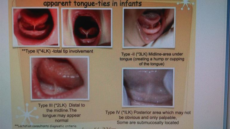 Короткая уздечка языка у ребенка