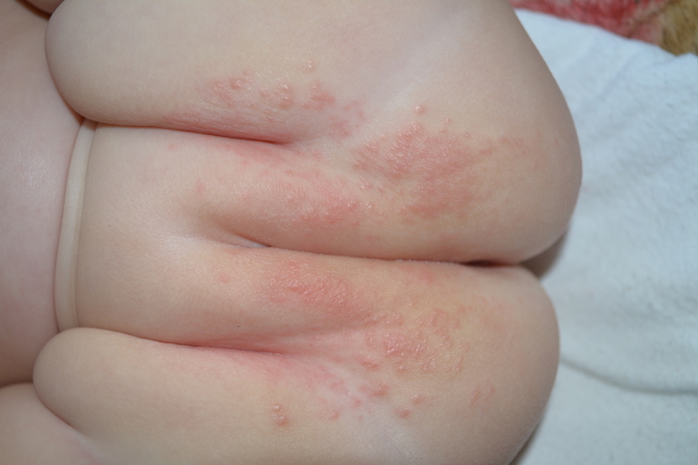 Масло черного тмина при атопическом дерматите у ребенка thumbnail