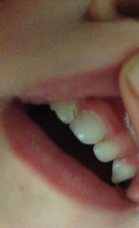 Как спасти зубки?