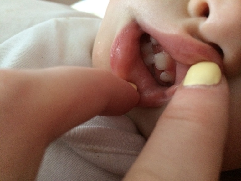 Чёрные точки на зубах