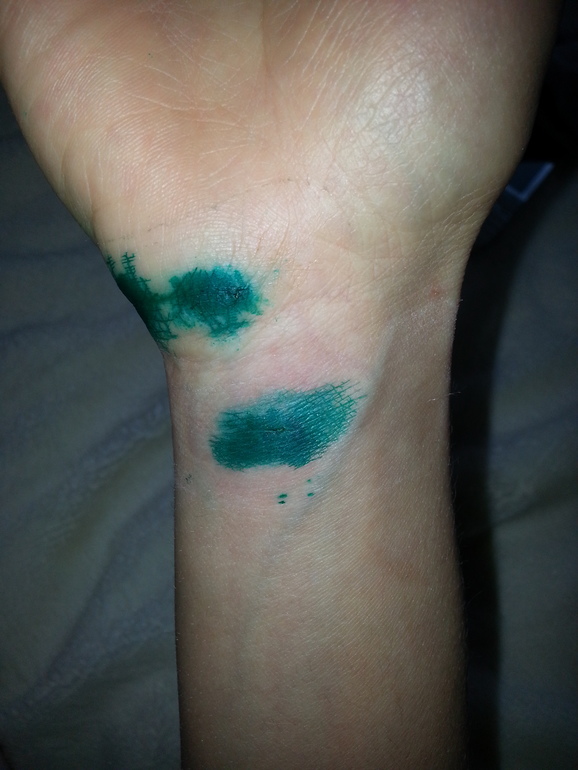 Хелп!!! Укусил кот!