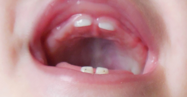 На первых двух зубах - кариес, что делать?