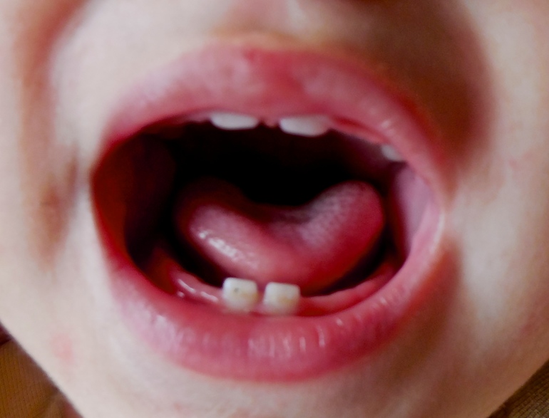 Беда с зубками, часть 2