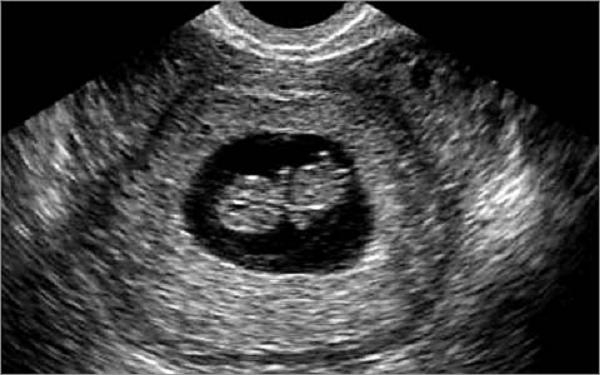Фото эмбриона на 6 неделе беременности фото