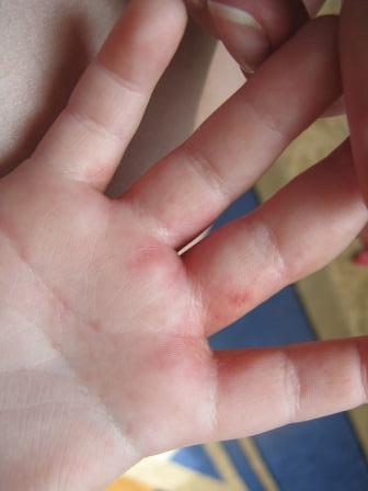 Сыпь и краснота между пальчиков