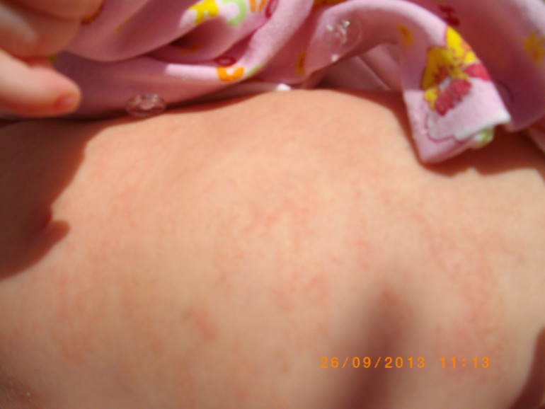 Сыпь....Может кто то знает что это такое, оно еще и шелушится....