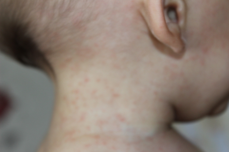 Потница или аллергия?