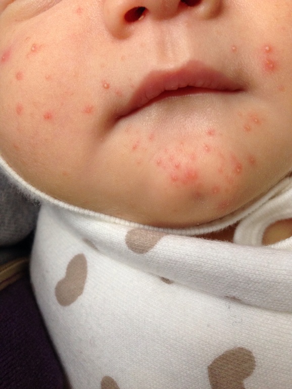 Что это за прыщички?(((((