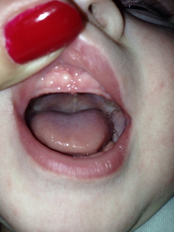 Десна бугорком