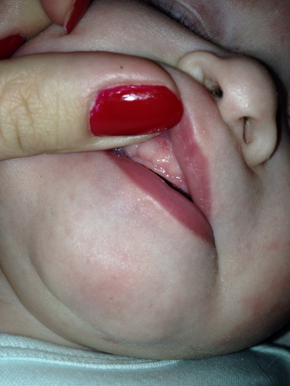 Десна бугорком