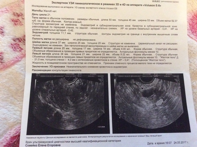 Эндометрий 3 мм. Ультразвуковое исследование матки при беременности. УЗИ небеременной матки.